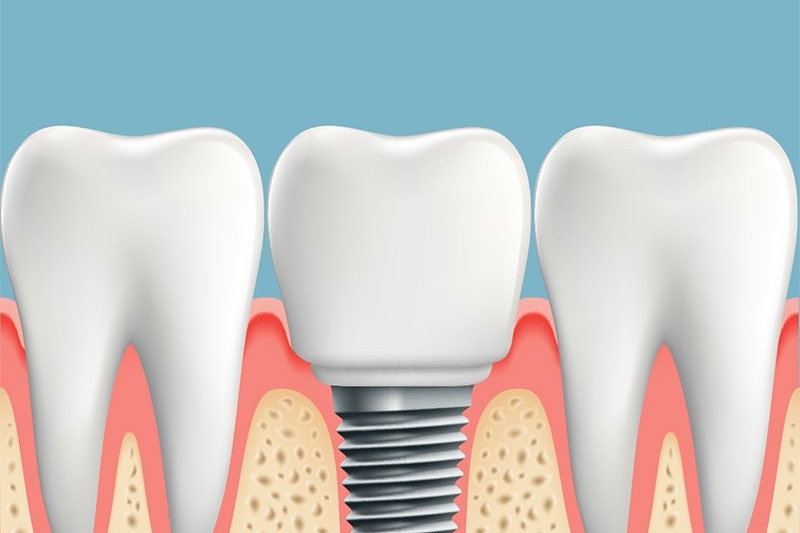 info about dental implants